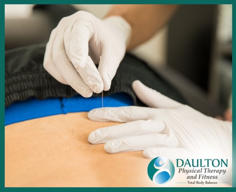 Dry Needling Demystified