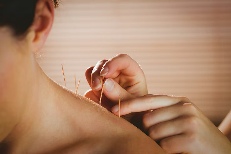 What is Dry Needling?
